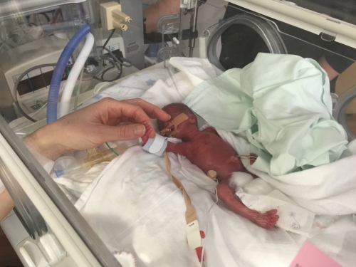 Daisy Salter, born at 23 weeks in Auckland City Hospital